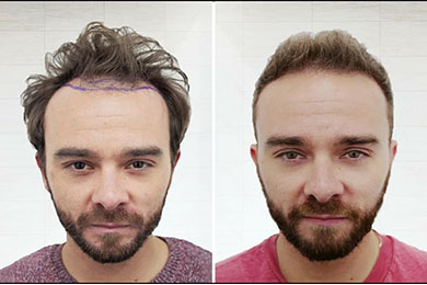 Saç Ekimi Öncesi ve Sonrası